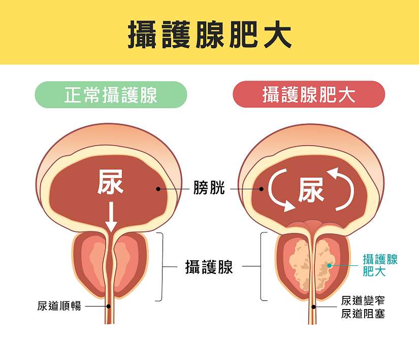 攝護腺肥大微創治療的新時代 Rezum水蒸氣消融與雷射攝護腺手術